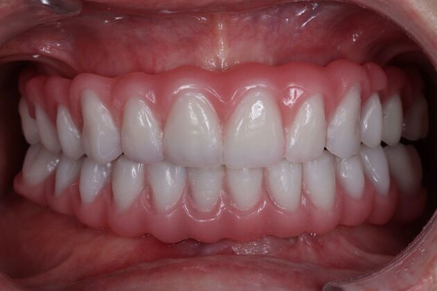 Dental Implants: Silvia - Fixed Hybrid denture - After