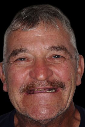 All-On-4/6: Layne - Hybrid prosthesis of PEEK - Before