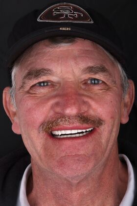 All-On-4/6: Layne - Hybrid prosthesis of PEEK - After