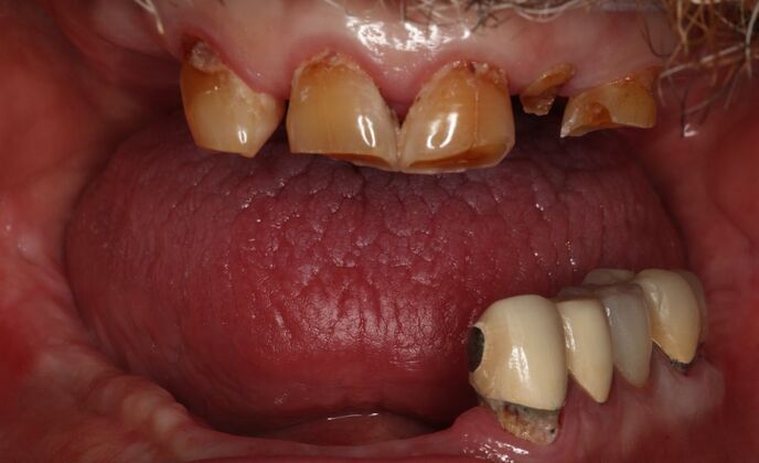 All-On-4/6: Layne - Hybrid prosthesis of PEEK - Before