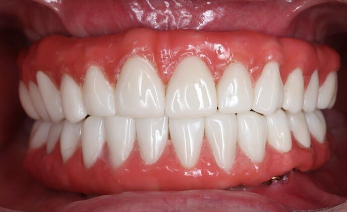 All-On-4/6: Layne - Hybrid prosthesis of PEEK - After