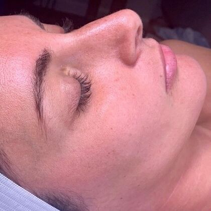 Hydrafacial: Case 1 - Before