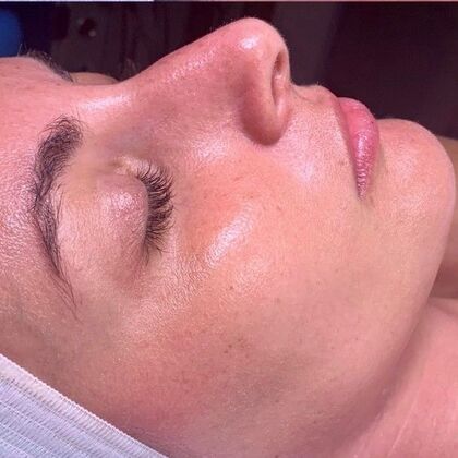 Hydrafacial: Case 1 - After