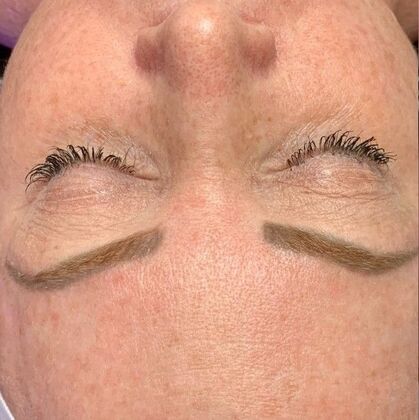 Hydrafacial: Case 2 - Before