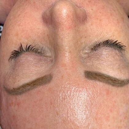 Hydrafacial: Case 2 - After