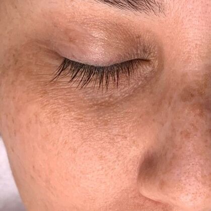 Hydrafacial: Case 3 - Before