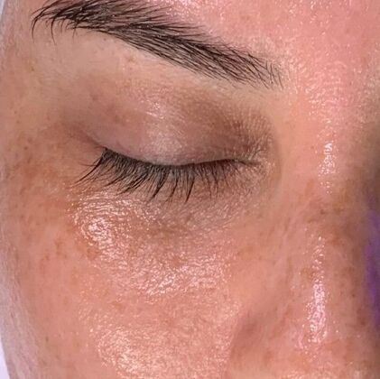 Hydrafacial: Case 3 - After