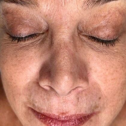 Hydrafacial: Case 4 - Before