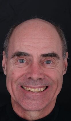 Full Mouth Restoration Wade - Zirconium Crowns - Before