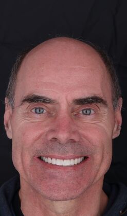 Full Mouth Restoration Wade - Zirconium Crowns - After