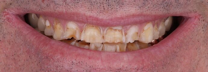 Full Mouth Restoration: Wade - Zirconium Crowns - Before