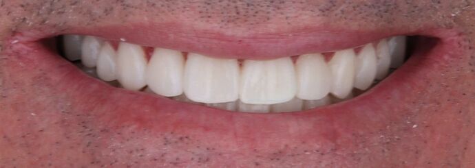 Full Mouth Restoration: Wade - Zirconium Crowns - After