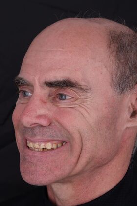 Full Mouth Restoration: Wade - Zirconium Crowns - Before