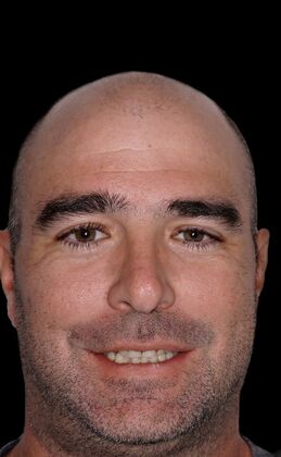 Full Mouth Restoration Jerry-zirconium crowns - Before