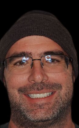 Full Mouth Restoration Jerry-zirconium crowns - After