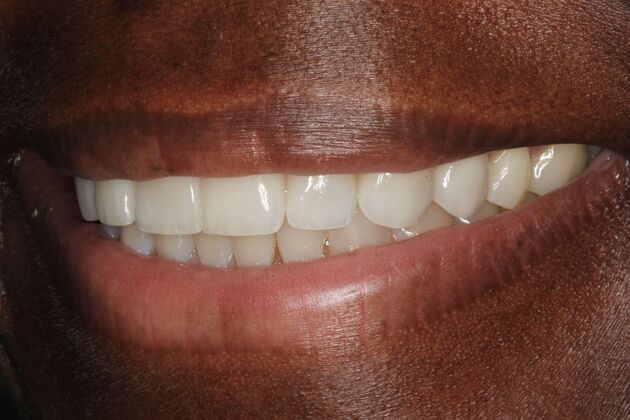 Cosmetic Dentistry: Veneers - After