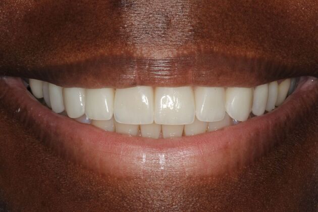 Cosmetic Dentistry: Veneers - After