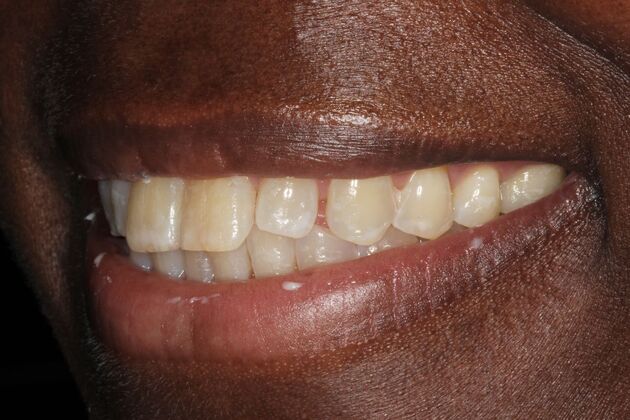 Cosmetic Dentistry: Veneers - Before