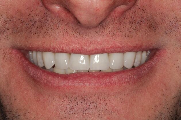 Cosmetic Dentistry: Teeth Veneers - After