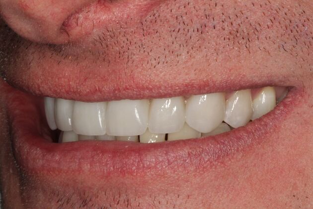Cosmetic Dentistry: Teeth Veneers - After