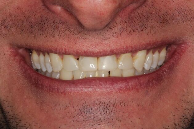Cosmetic Dentistry: Teeth Veneers - Before