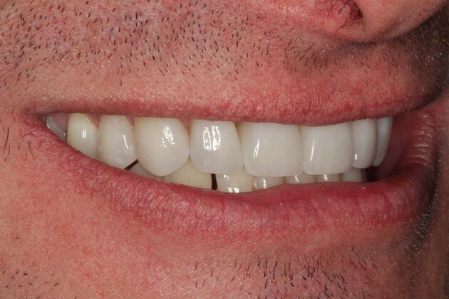 Cosmetic Dentistry: Teeth Veneers - After