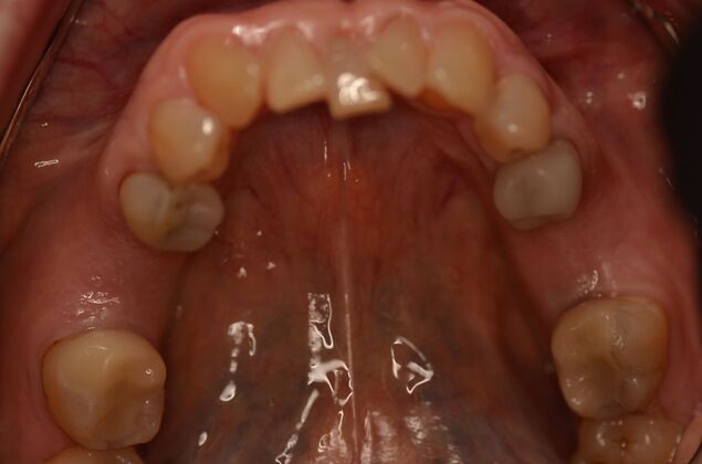 Dental Implants: Case 58 - Before