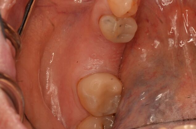 Dental Implants: Case 58 - Before