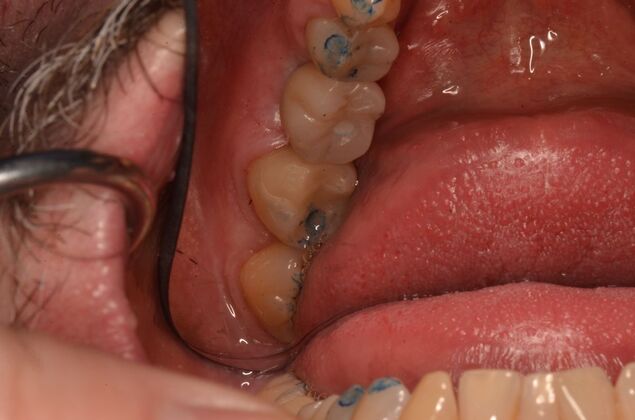 Dental Implants: Case 58 - After dental implant and crown