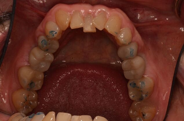 Dental Implants: Case 58 - After dental implants, blue marks to check the bite
