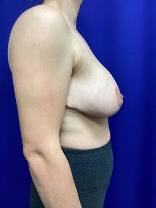 Breast Lift / Mastopexy: Case 42 (3505122) - After