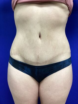 Body Tummy Tuck / Abdominoplasty: Case 24 (2070557) - After