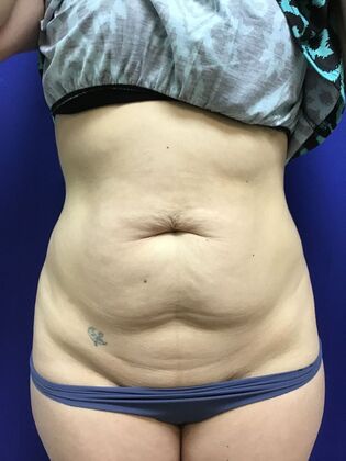 Body Tummy Tuck / Abdominoplasty: Case 24 (2070557) - Before