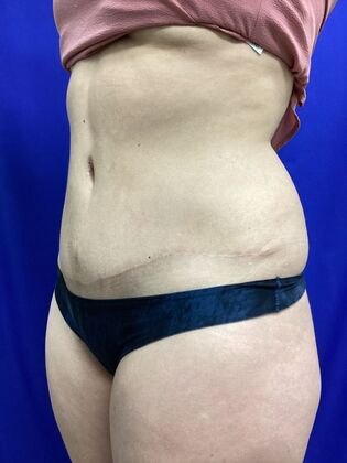 Body Tummy Tuck / Abdominoplasty: Case 24 (2070557) - After