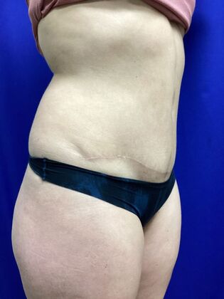 Body Tummy Tuck / Abdominoplasty Case 24 (2070557) - After