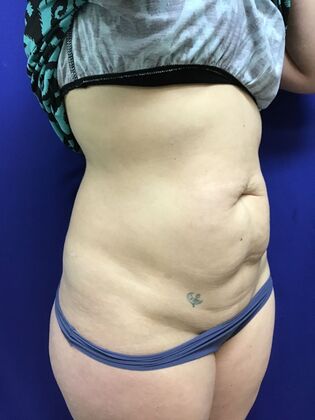 Body Tummy Tuck / Abdominoplasty Case 24 (2070557) - Before