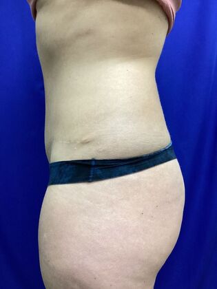 Body Tummy Tuck / Abdominoplasty: Case 24 (2070557) - After