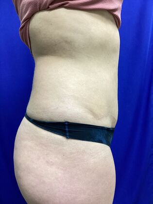 Body Tummy Tuck / Abdominoplasty: Case 24 (2070557) - After