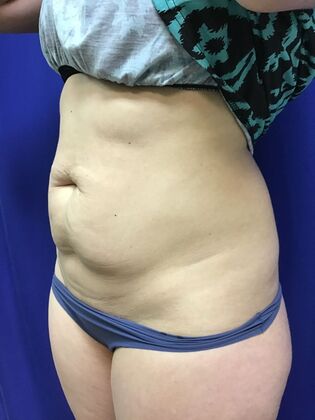 Body Tummy Tuck / Abdominoplasty: Case 24 (2070557) - Before