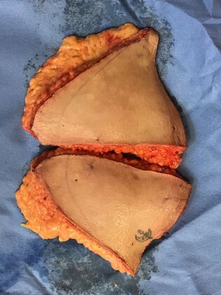 Body Tummy Tuck / Abdominoplasty: Case 24 (2070557) - Skin & fat removed. The right side is toward the bottom of the photo.  The photo left side was the former location of the belly button.