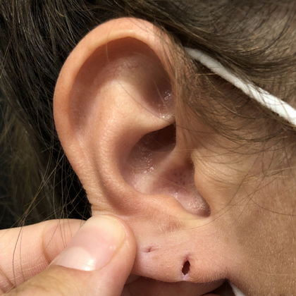Split Earlobe Repair Case 1 - Before