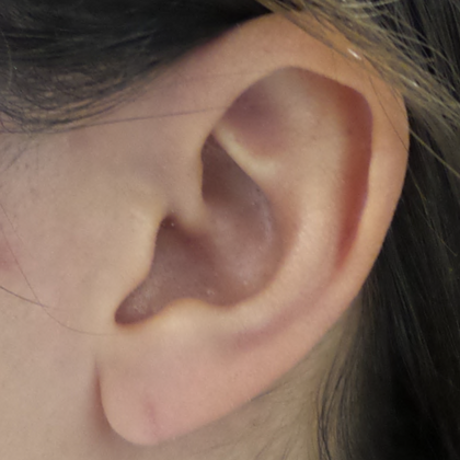 Split Earlobe Repair Case 4 - After