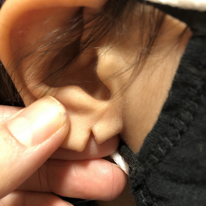 Split Earlobe Repair Case 5 - Before