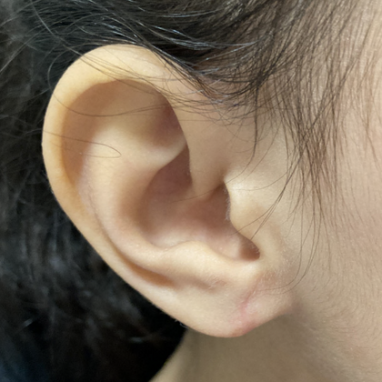Split Earlobe Repair Case 5 - After