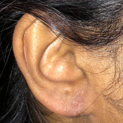 Split Earlobe Repair Case 6 - After