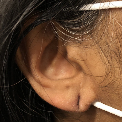 Split Earlobe Repair Case 6 - Before