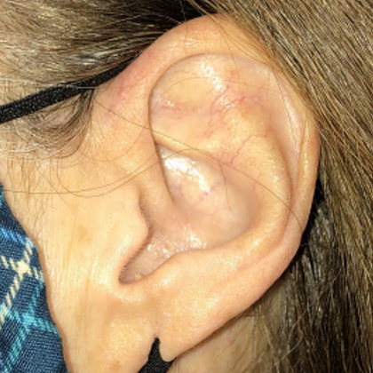 Split Earlobe Repair Case 7 - Before