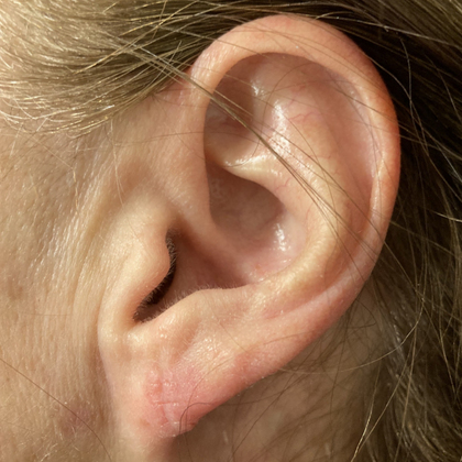 Split Earlobe Repair Case 7 - After