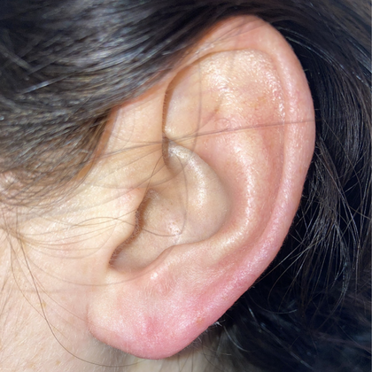 Split Earlobe Repair Case 8 - After