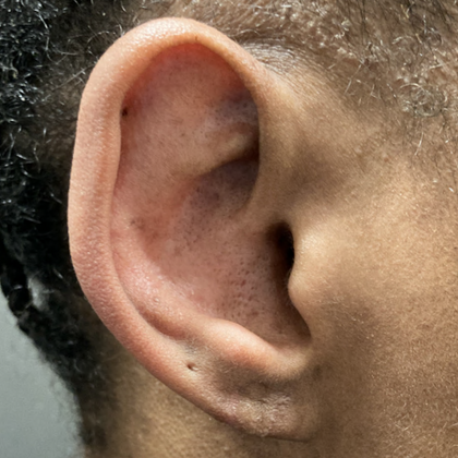 Split Earlobe Repair Case 9 - After
